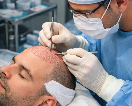 FUE hair transplant procedure with surgeon placing grafts on male hairline