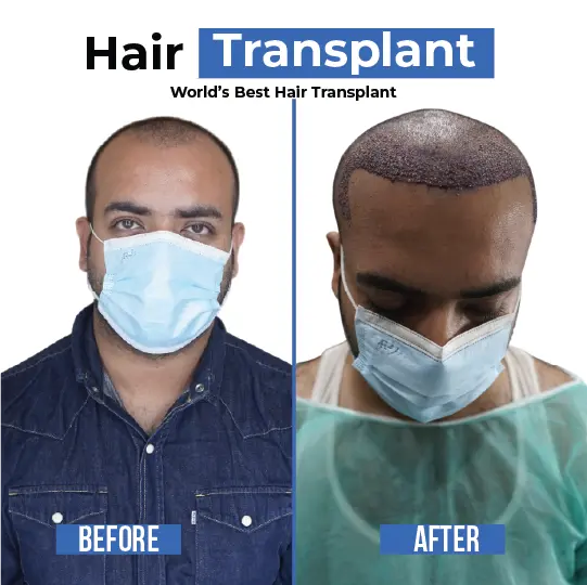 Hair transplant before and after results showing FUE graft placement on bald scalp