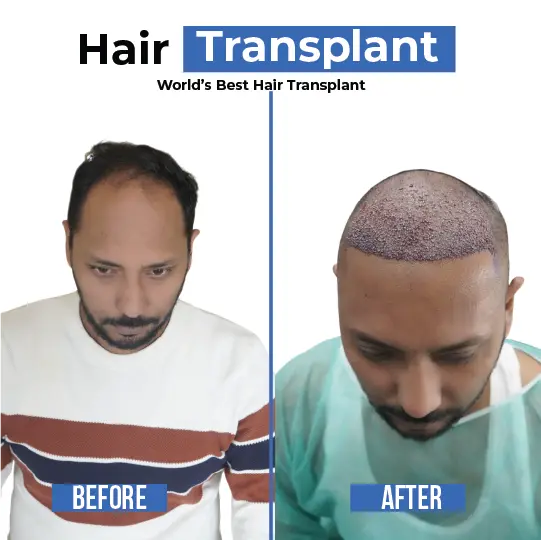 Male hair transplant before and after showing receding hairline restoration results