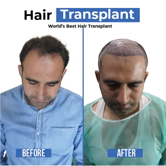 Hair transplant before and after showing crown and hairline restoration in male patient